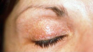 Eczema de contact à un vernis à ongle