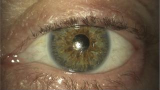 Prothèse oculaire après éviscération ou énucléation